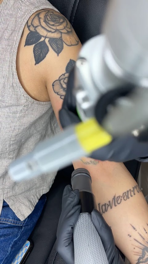 PYS Laser Tattoo Removal