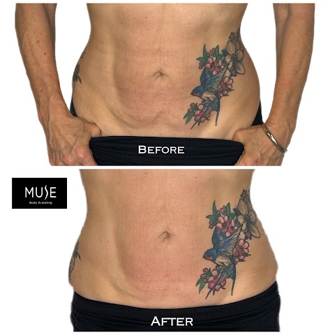 Muse Body Sculpting